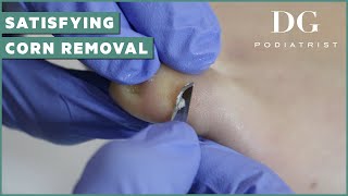 Satisfying corn removal on pinky toe  The Foot Scraper DG Podiatrist [upl. by Retepnhoj]