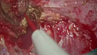 Lateral temporal bone resection by prof dr jaskaran singh [upl. by Missi]