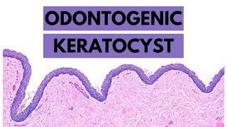 Odontogenic Keratocyst Clinical features Radiology Histology and Treatment [upl. by Ecinaej]