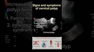 Signs amp Symptoms of Cervical Polyps healthytips shortsbeta ultrasound ytshort DrSaimakhan [upl. by Mattie778]