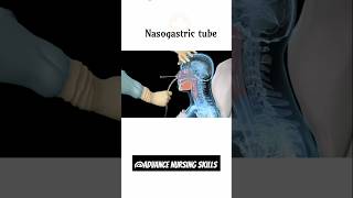 Nasogastric tube youtubeshorts ytshorts trendingshorts newvideo nasogastric tube [upl. by Nylatsirk742]