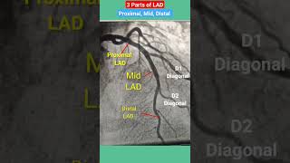 Proximal mid distal LAD  Left anterior descending artery angiography shorts [upl. by Alicea]