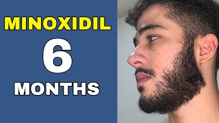 Minoxidil Beard Journey 6 MONTHS TRANSFORMATION [upl. by Akenahc]