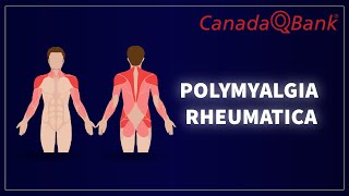 Polymyalgia Rheumatica [upl. by Nelyk552]