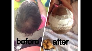 Sagittal CraniosynostosisRyKs Journey [upl. by Nylteak]