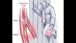 Peripheral Arterial Disease [upl. by Ydniw358]