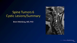 Spine tumors 6 – Cysts and Summary [upl. by Edan194]