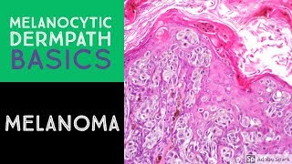 Melanocytic Dermpath Basics Melanoma [upl. by Anon532]