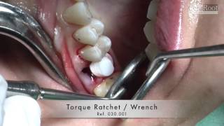 Placement of a CeraRoot 16 zirconia implant after extraction [upl. by Ozzie253]