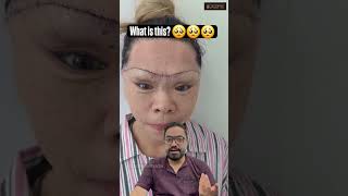 Plastic surgeon reaction on Browlift [upl. by Dwinnell318]