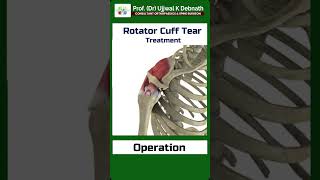 Treatment of rotator cuff tear   Dr Ujjwal K Debnath [upl. by Eivad]