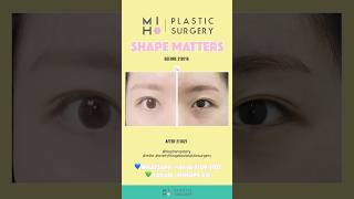 Blepharoplasty mihoplasticsurgerykorea4827 [upl. by Rika]