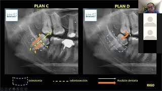 Planificando la extracción del 3°molar inferior [upl. by Bowler]