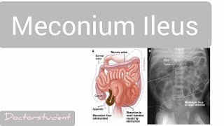 Meconium Ileus [upl. by Rosmarin40]