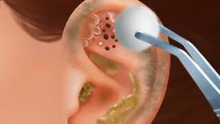 Itchy amp Smelly Ear Stone Removal Digging Out Super Big Earwax  ASMR Animation  Mengs Stop Motion [upl. by Janith]