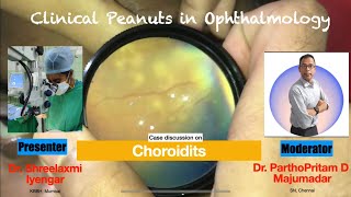 Case discussion on Choroiditis [upl. by Garda524]