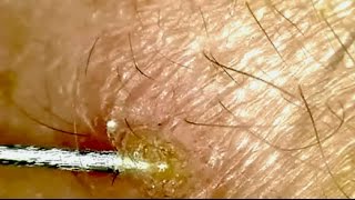 Magnified Pimple Scab Picking [upl. by Asilehc]