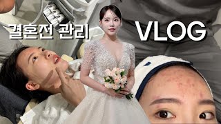 vlog 본식 한달 남기고 여드름 폭탄 날것의 민낯ㅣ 피부 복구 브이로그ㅣ결혼전 시술 추천ㅣ루비레이저ㅣ리프팅ㅣ여드름레이저 [upl. by Yettie]