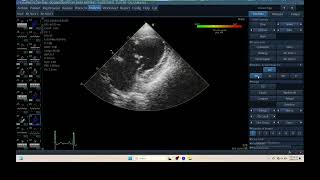 IQ 306 TSI TISSUE SYNCHRONY IMAGING ECHOPAC ANALYSIS ECHOCARDIOGRAPHY HEPATOMA PTE [upl. by Airat492]