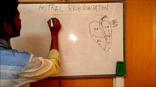 MITRAL REGURGITATION  DEFINITIONCAUSESSIGNSSYMPTOMSPATHOPHYSIOLOGY AND TREATMENT [upl. by Adlig]