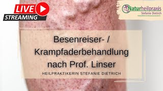 Sanfte Saline Besenreiser amp Krampfaderbehandlung nach Prof Linser  ambulant  Heilpraktiker [upl. by Ellehcer]