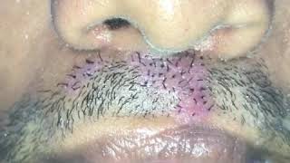 Designer natural growing Moustache video  Dr Sunil Richardson [upl. by Dania]