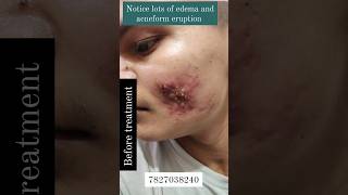 Acne treatment youtubeshorts dermatologist skincare trending shivratri [upl. by Ellebyam]