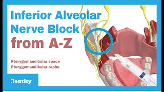 Inferior Alveolar Nerve Block  AZ [upl. by Fatimah]