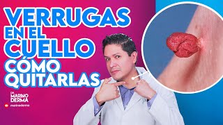 VERRUGAS EN EL CUELLO COMO QUITARLAS Tips de un dermatologo [upl. by Karylin]