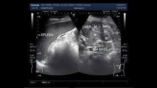 Ultrasound Video showing hepatic parenchymal disease with multiple masses and splenomegaly [upl. by Vogele]