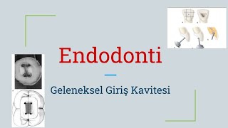 Giriş Kavitesi Prensipleri  Endodonti Dersleri [upl. by Felicio341]