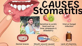 Stomatitis Chapter1 Disease1 AHN 3rd semester kmu slides in pashto drnajeebnote drnajeeb kmupdat [upl. by Gilges]