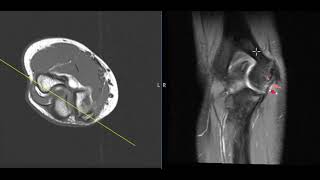 Chronic little leaguers elbow and partial tear of ulnar collateral ligament [upl. by Hauck]