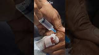 local anesthetic injection  anesthesia technique  Lidocaine 2 [upl. by Nyladnarb]