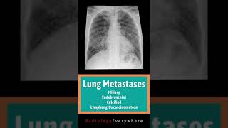 Lung Metastases Miliary Endobronchial calcified Lymphangitic carcinomatosis Radiology Video 40 [upl. by Dlonyer]