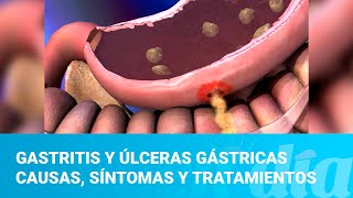 Gastritis y úlceras gástricas causas síntomas y tratamientos [upl. by Ehtyde]