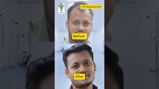 12 Months Hair Transplant Result [upl. by Casimire135]