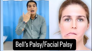 Bells Palsy  Facial Palsy Best Tips and exercise Fast Recovery Dr Pritam Singh [upl. by Ballou]