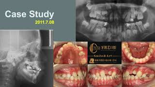 Continuous archwire technique for the correction of completely transposed maxillary incisors [upl. by Anaeco]