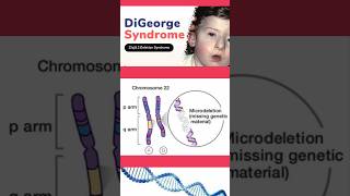 Digeorge syndrome  Microdeletion  Genetic disorder  ytshorts syndrome geneticdisorder [upl. by Lekym]