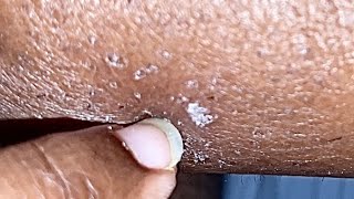 ASMR DRY SKIN FLAKES SCRATCHING AND PICKING W INGROWN HAIR PLUCKING [upl. by Hijoung]