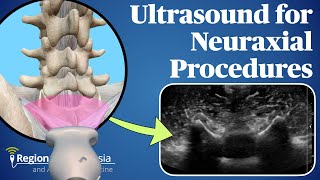 Ultrasound for Neuraxial Procedures [upl. by Yesrod]