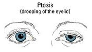 Ptosis MY Before amp After [upl. by Mozelle]