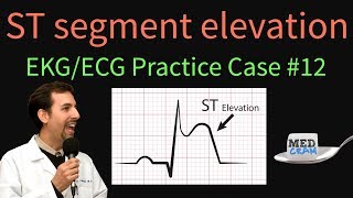 ST Elevation  EKG  ECG Interpretation Case 12 STEMI MI ACS [upl. by Enileda]