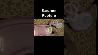 Ruptured Eardrum  3D Animation 👂 [upl. by Ettennahs245]