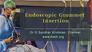 Endoscopic Grommet Insertion  Dr G Sundhar Krishnan Chennai [upl. by Setsero]