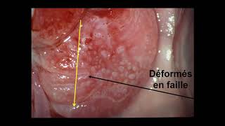 J MARCHETTA  Panorama des aspects colposcopiques  du col normal au cancer [upl. by Assiralc572]