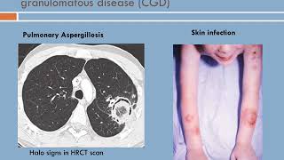 Immunocompromised host [upl. by Barthold]