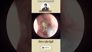 rhinorrhea sinusitis bersihkankuping satisfyingvideos pembersihan telinga video puas hati [upl. by Sanchez]