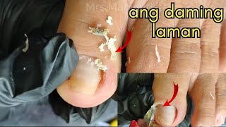 Vlog 991Dry SkinIngrown Removal PEDICURE 891 [upl. by Brandise]